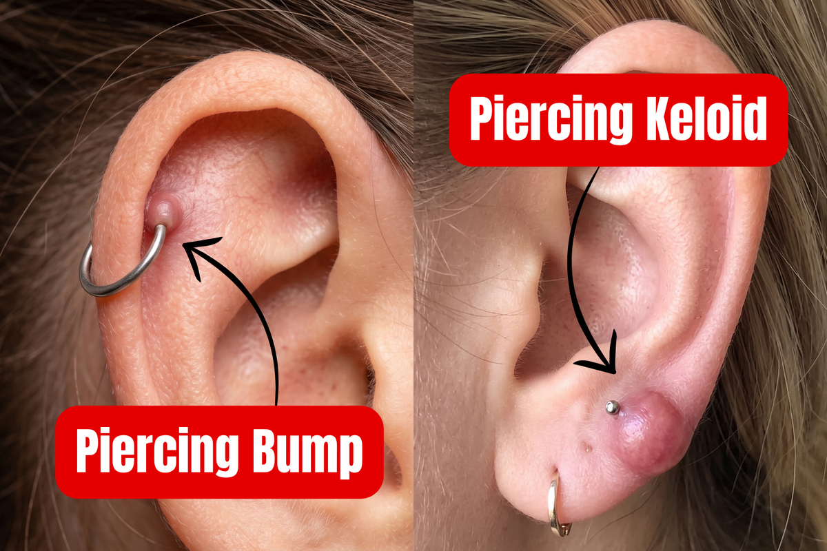 Image showing the difference between piercing bump and keloid. 